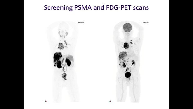 PSMA Directed Theranostics: A Few Examples of Clinical Cases | Vumedi