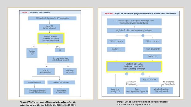 Mechanisms of Bioprosthetic Mitral Valve Thrombosis and Management ...