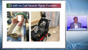 PowerWire Pro RF Guidewire to Treat Chronic Venous Obstruction | Vumedi