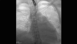 Removal of a Trapped Swan After MICS Mitral Valve Repair | Vumedi