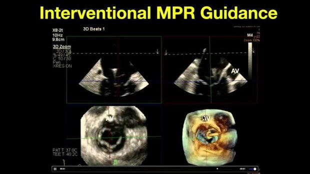 Live 3D MPR Imaging for Structural Interventions - A Primer | Vumedi