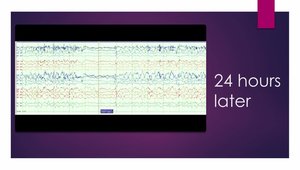 Management of Status Epilepticus: 90 yo Woman Presenting With Right ...