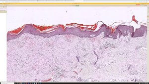 Scar & Biopsy Site Change Under the Microscope: How to Evaluate Skin ...