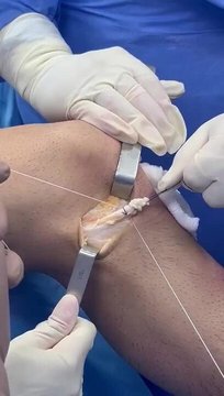 LET Procedures. Modified Ellison Technique | Vumedi