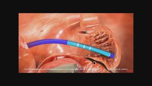 Watchman Implantation: Tips and Tricks | Vumedi