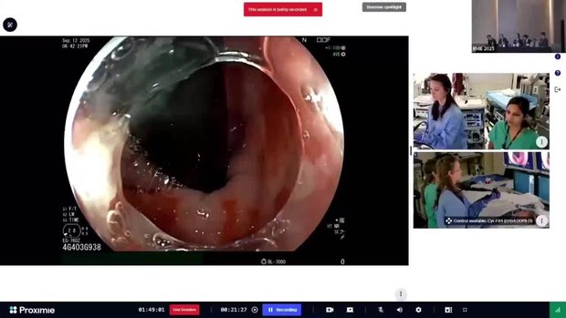 Live EGD with RFA for Barrett’s Esophagus | Vumedi