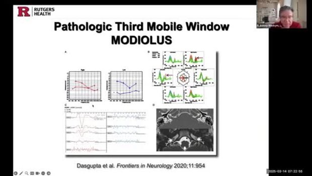 Third Window Syndrome and Superior Canal Dehiscence: Cognitive Impact ...