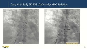 Advanced 3D ICE: A Review of Challenging Cases and What I Learned | Vumedi