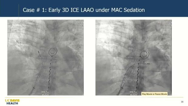 Advanced 3D ICE: A Review of Challenging Cases and What I Learned | Vumedi