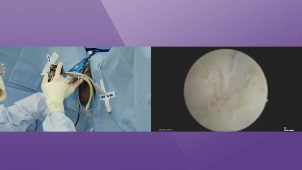 HoLEP Semi-Live Surgery: Second Generation Pulse Modulation Technology ...