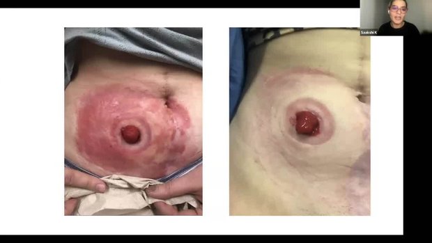 Derm/Rheum Talks Series: Dermatological Conditions Associated with IBD ...
