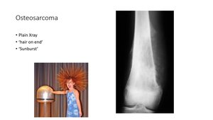 Radiographic Assessment of Bone Tumors: Location, Tumor-Bone ...