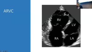 How I Manage PVCs/VT | Vumedi