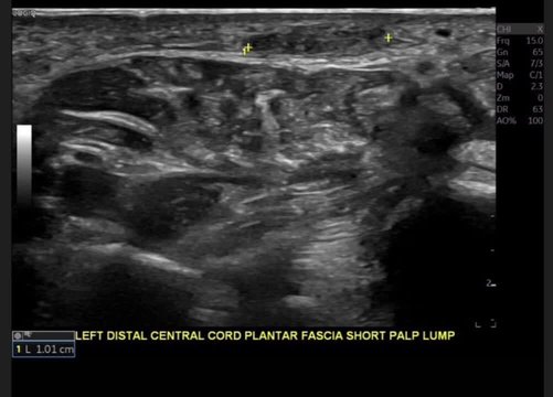 bpc 157 + kpv 5-Step Protocol for a Targeted Ultrasound of a Plantar Fibroma in the Foot
