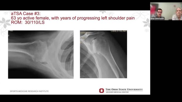 3D Planning in Primary Shoulder Arthroplasty Cases: Navigating Complex ...