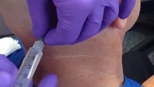 How to Perform Occipital Nerve Block for Treatment of Chronic Migraine ...