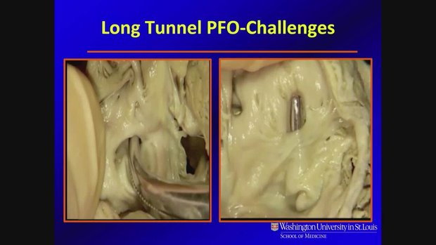 PFO Closure and High Risk Anatomy | Vumedi