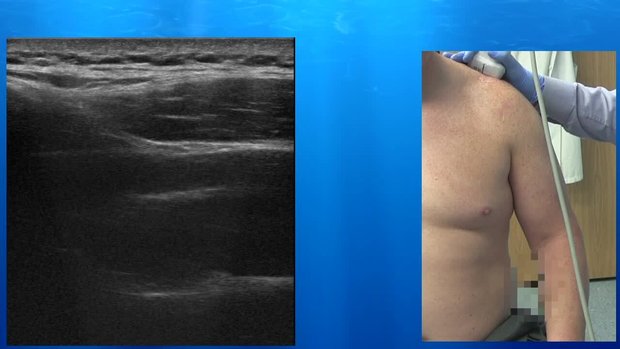 Supraspinatus Tendon Tear, AC Joint and Suprascapular Notch Ultrasound