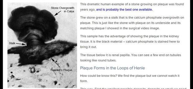 How Kidney Stones Form | Vumedi