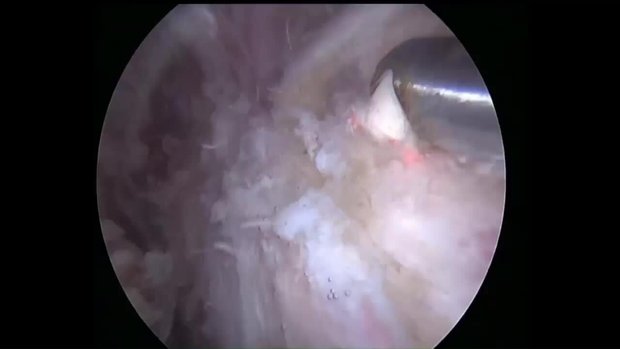 Lower Trap Transfer for Irreparable RCR | Vumedi