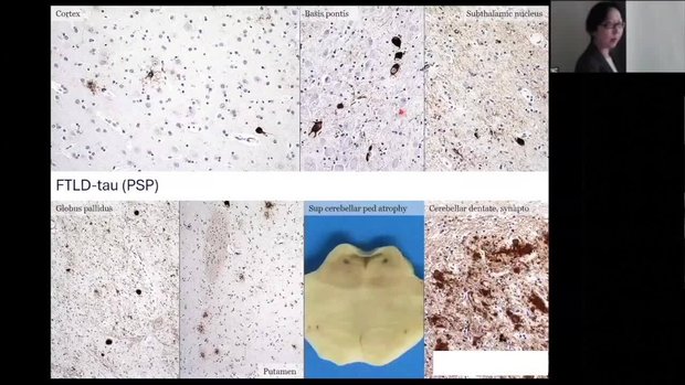 Introduction To The Autopsy Program For Neurodegenerative Disease | Vumedi