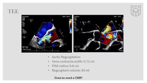 Case Presentation: 72 y/o male with Aortic Regurgitation | Vumedi