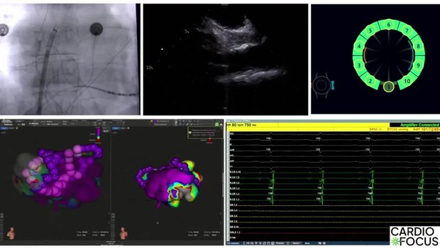 PerAF Ablation Using QuickShot, Large Area/Focal PFA Catheter ...