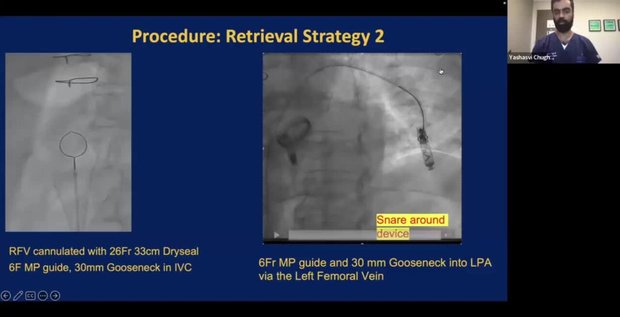 TCT 2025 Insights: Percutaneous Retrieval of Embolized Avier Leadless ...