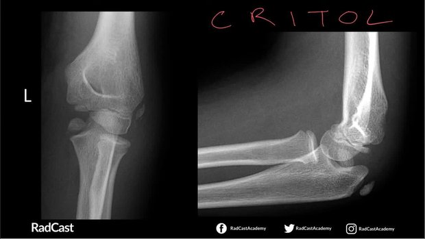 Elbow X-Ray: Using CRITOL to Interpret the Paediatric Elbow X-Ray | Vumedi