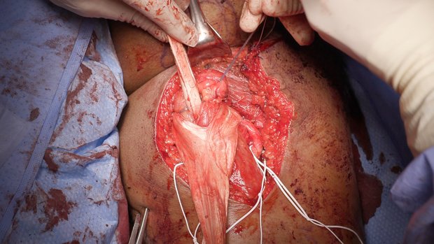 bpc 157 for hamstring strain BPC 157