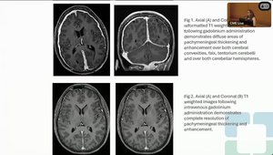 Central Nervous System Involvement in Vasculitis | Vumedi
