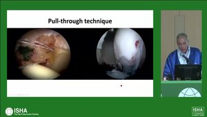 Labral Reconstruction: The Whole Kit and Kaboodle | Vumedi