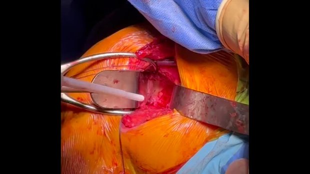 Distal Tibial Allograft Glenoid Reconstruction | Vumedi