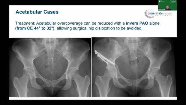 Open Techniques in FAI: When Surgical Dislocation May Be the Best ...