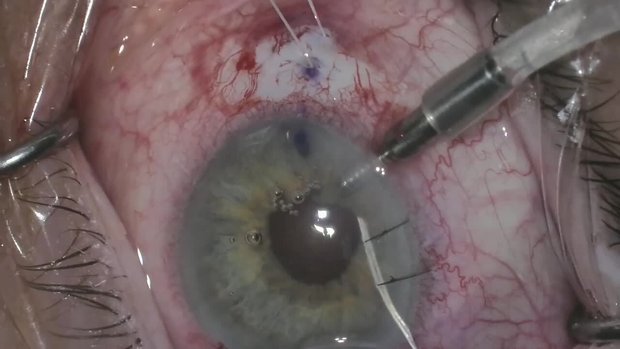 Scleral Sutured MX60 IOL in a Post-Vitrectomized Eye | Vumedi