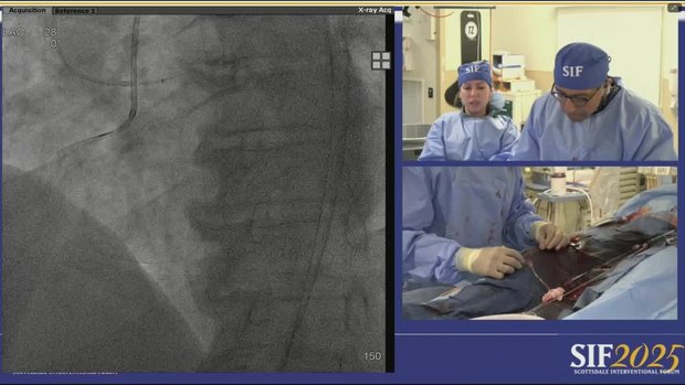 Chronic Total Occlusion in RCA With Severe Obesity: Retrograde PCI ...