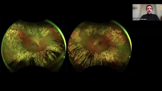 FLORetina-ICOOR 2025 Insights: Gyrate Atrophy of the Choroid and Retina ...