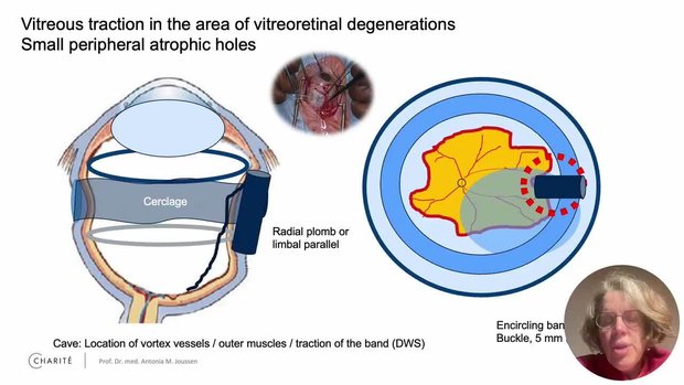 FLORetina-ICOOR 2025 Insights | Vumedi