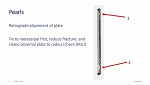 Dorsal Spanning Plates for Distal Radius Fractures | Vumedi