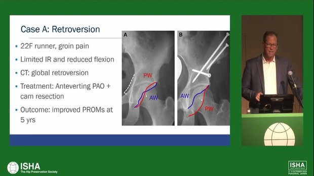 Treatment Algorithms for Acetabular Retroversion, Anteversion and Under ...