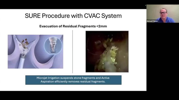 CVAC System Procedure: Key Steps and Technical Pearls | Vumedi