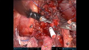 Redo Pyeloplasty Using Y-V Plasty via Retroperitoneal Approach with the ...