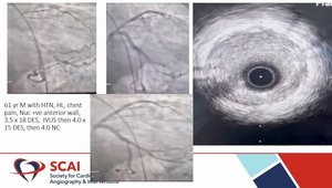 How IVUS Changed My PCI | Vumedi