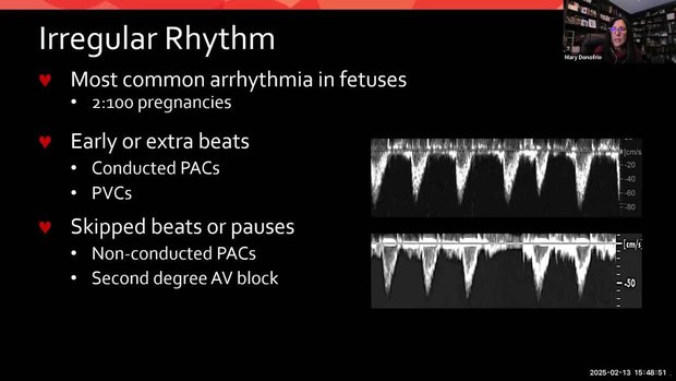 SMFM 2025 Insights - Fetal Arrhythmia: Diagnosis and Management | Vumedi