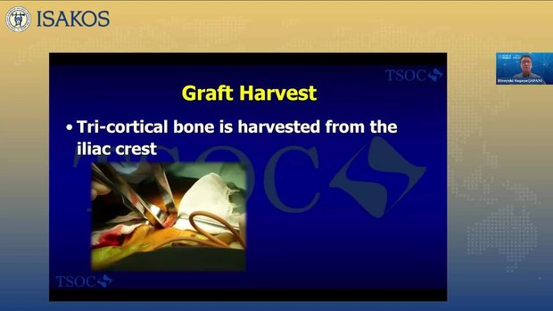 Dealing with Bone Defects in Shoulder Instability: Free Bone Grafting ...
