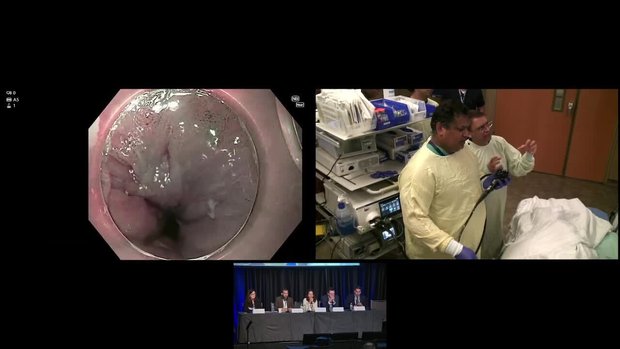 Live EGD with Radiofrequency Ablation (RFA) for Intestinal Metaplasia ...