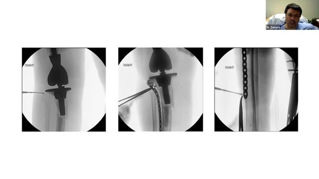 Treating Periprosthetic Tibia Fractures | Vumedi