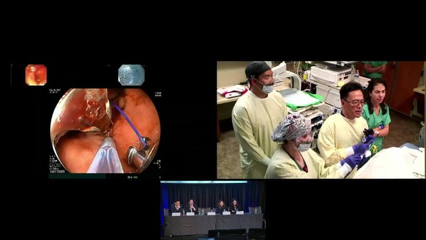 Live ESG & Resection and Plication (RAP) | Vumedi