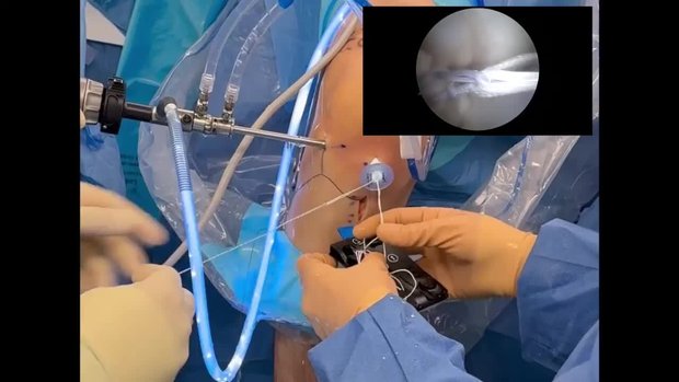bpc 157 acl repair Heal faster after surgery. BPC-157 & TB500 boost repair, reduce inflammation, and speed recovery. Get back stronger, sooner The Hidden Risks of BPC157: