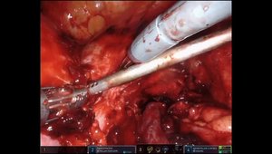 The Use of the Uterine Artery for Bladder Flap Dissection | Vumedi